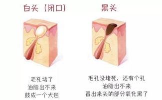 辨別黑頭與閉口，黑頭儀的正確使用與誤區